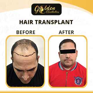 Hair Transplant